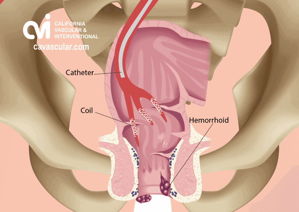 Hemorrhoid Artery Embolization (HAE): Results