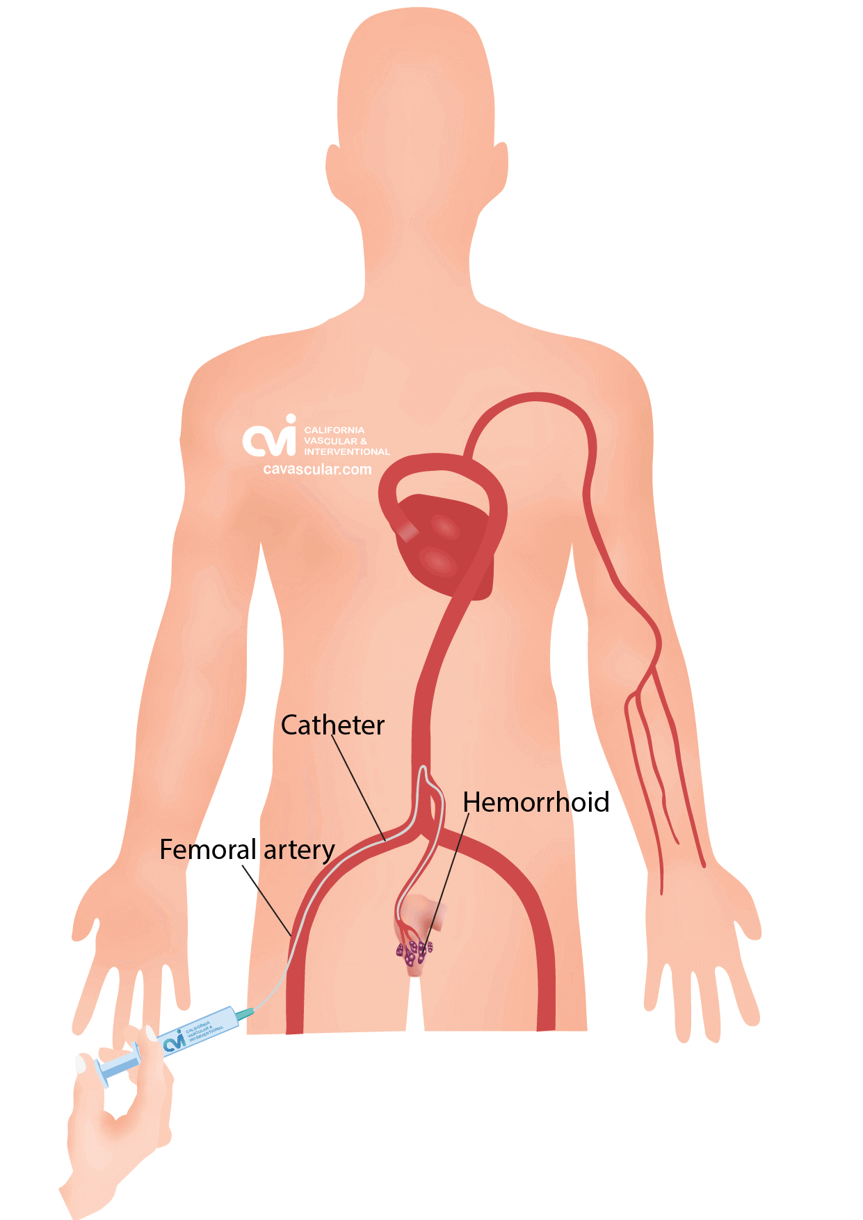 Hemorrhoid Artery Embolization (HAE): Procedure