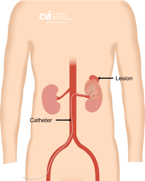 femoral artery approach catheter placement diagram for renal angiomyolipoma embolization Beverly Hills California Vascular