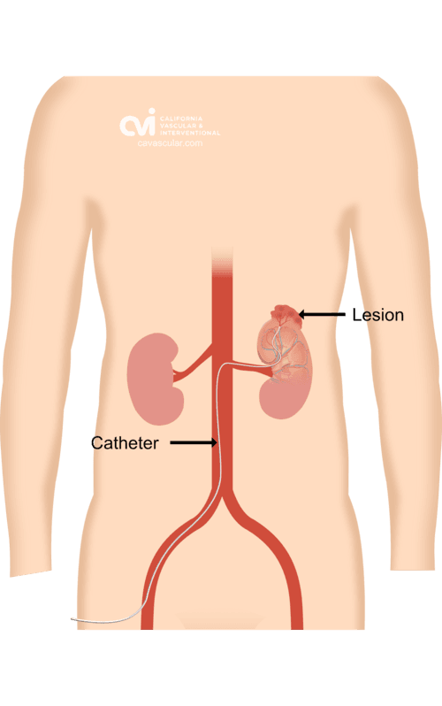 Angiomyolipoma Embolization
