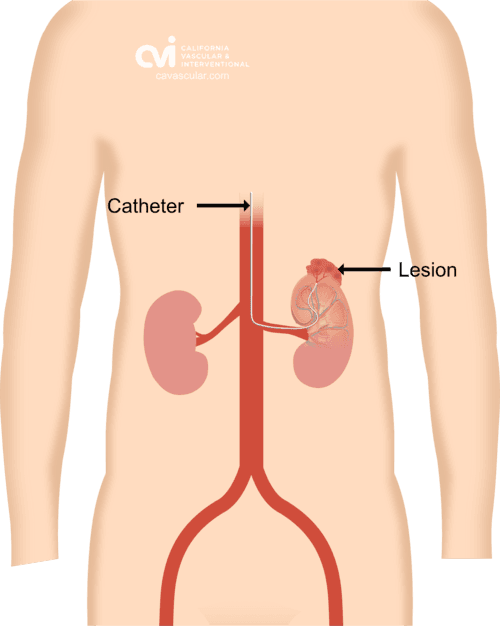 radial artery approach catheter placement diagram for AML angiomyolipoma embolization treatment by Dr Allaei Beverly Hills