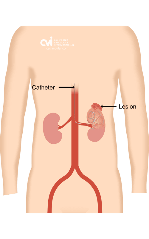Angiomyolipoma Non-Surgical Embolization