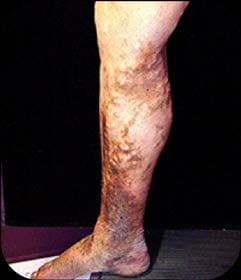 Deep Venous Thrombosis (DVT) Leg