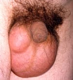 scrotal spermatocele clinical picture