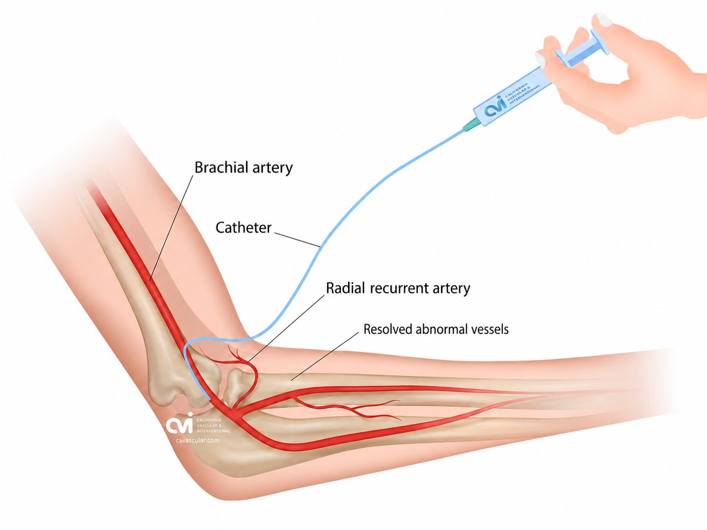 Tennis Elbow Embolization (TAME) 2 post embolization tennis elbow dr allaei illustration of elbow