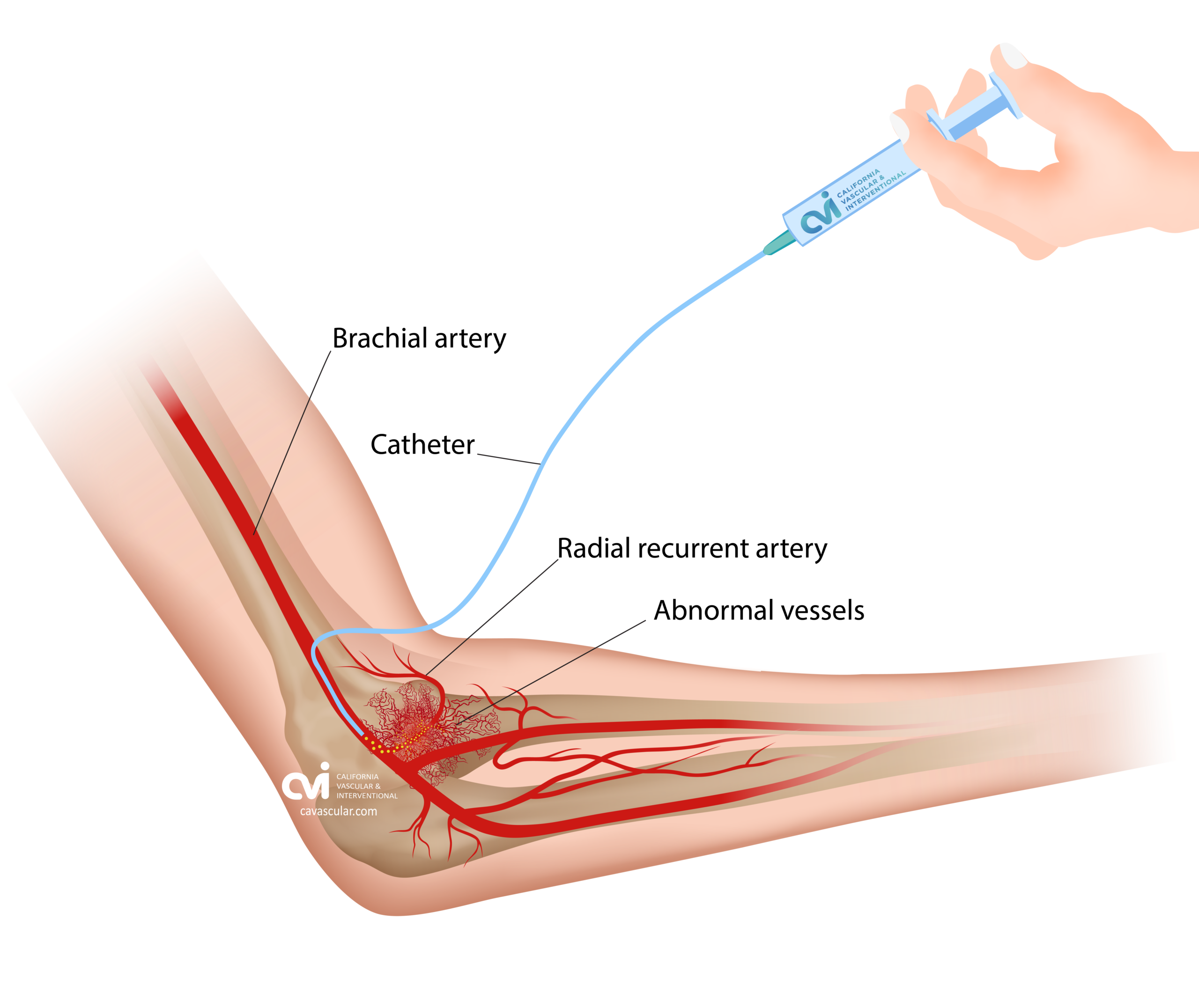Tennis Elbow Embolization (TAME) 1 IMG 7941