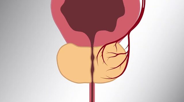 Enlarged Prostate 4 L3SKbpjCHe4 SD e1786350423909