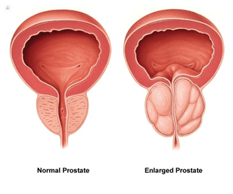 Enlarged Prostate 6 Diagram comparing a normal prostate with an enlarged prostate (BPH)