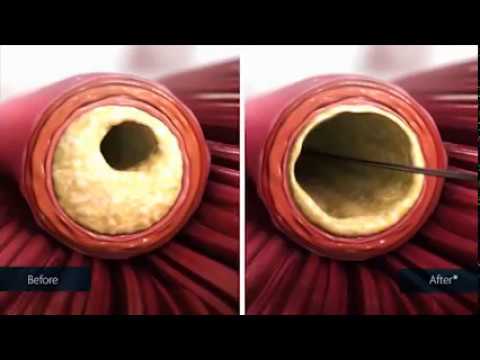 Peripheral Arterial Disease 16 CymyoT4kFQI HQ 1