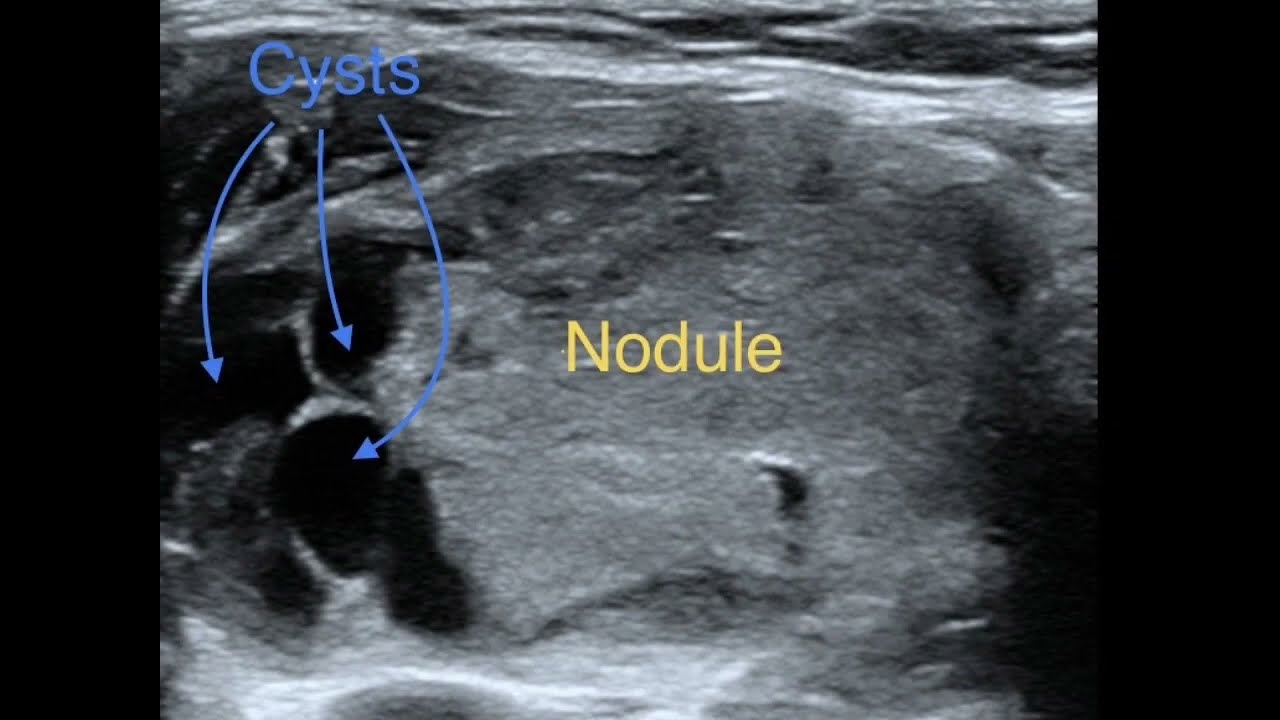 Thyroid RFA 2 X3010krGNhA HD